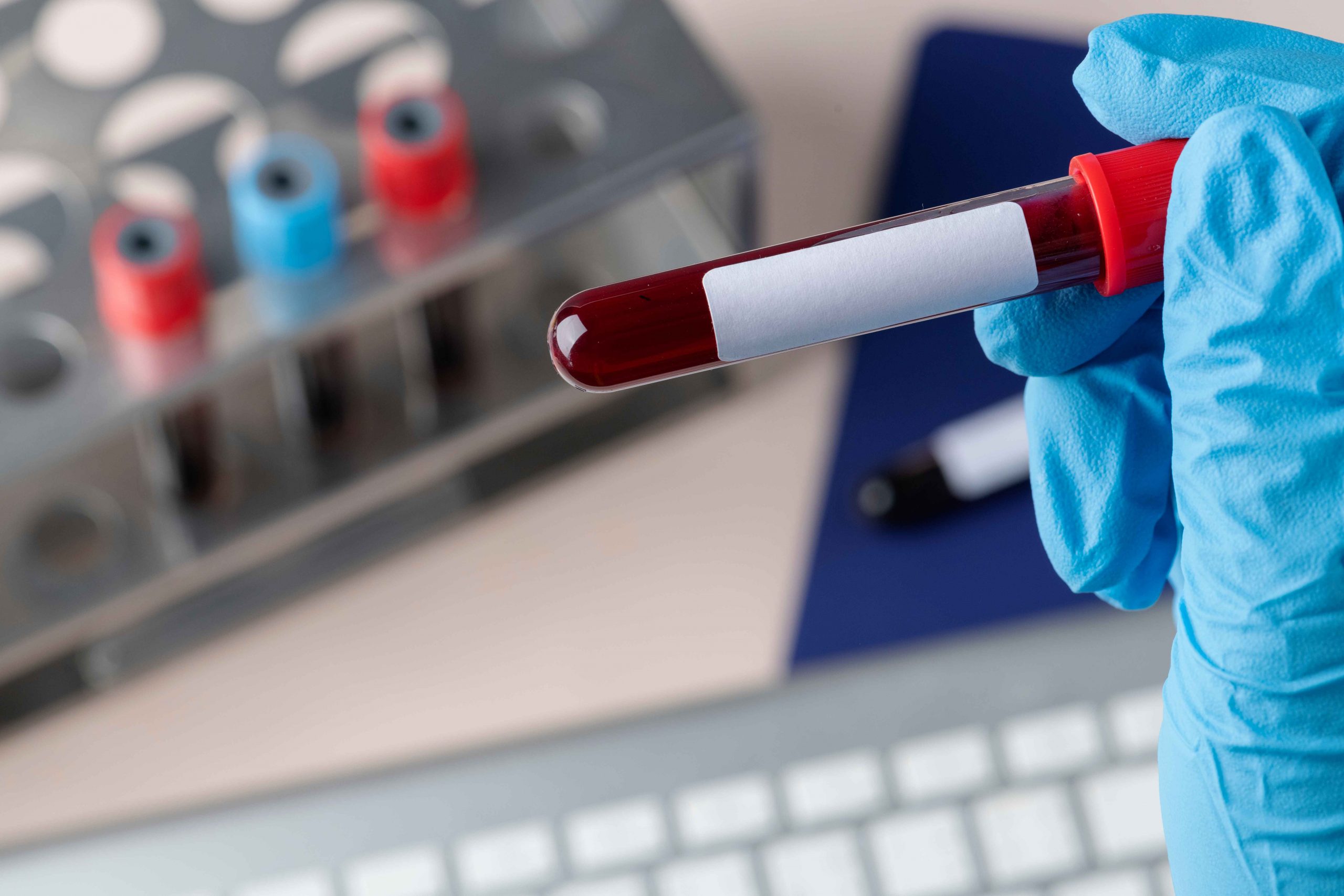Zwykły test krwi może wskazać ryzyko zawału